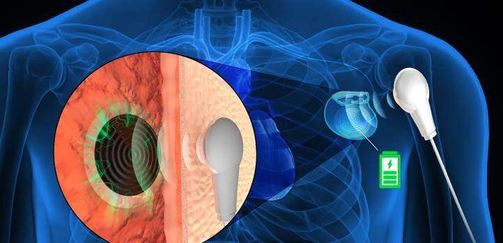 Remotely charge batteries through flesh for permanent implantable medical devices